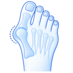 Hallux valgus